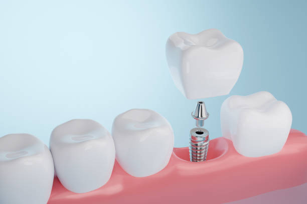 implante dental - implantes dentales fotografías e imágenes de stock