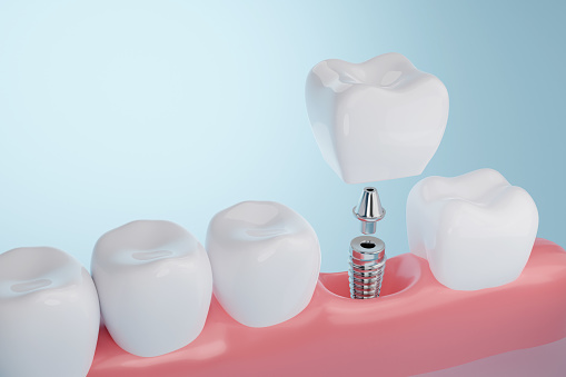 Healthy gums and Dental implant on blue background