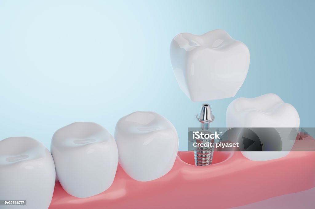 Dental implant Healthy gums and Dental implant on blue background Dental Implant Stock Photo