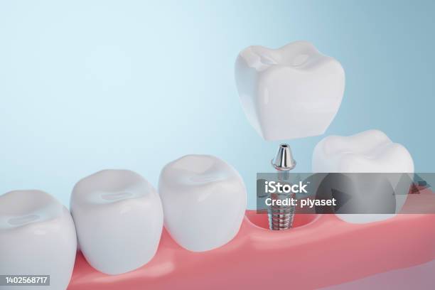 Dental Implant Stock Photo - Download Image Now - Dental Implant, Implant, Dental Health