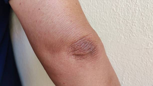 istock Crook of the arm, black elbow. 1402634879