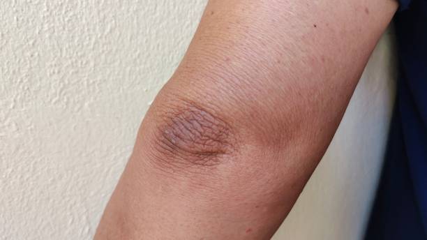 istock Crook of the arm, black elbow. 1402634945