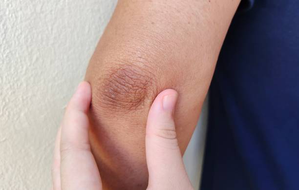 istock Crook of the arm, black elbow. 1402635076