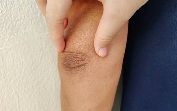 istock Crook of the arm, black elbow. 1402635113