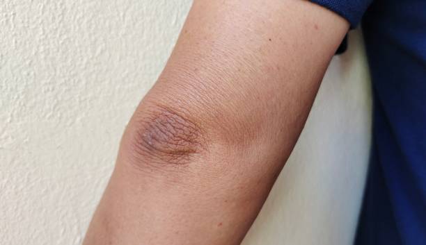 istock Crook of the arm, black elbow. 1402635691