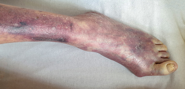 The leg of old female patient in very serious condition because of blood clot and varicose veins.