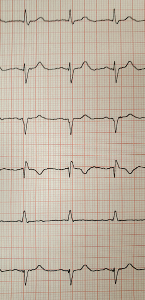 Emergency cardiology. ECG with supraventricular extrasystole and short paroxysm of atrial fibrillation