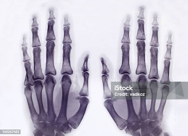 Xray Bilder Stockfoto und mehr Bilder von Anatomie - Anatomie, Daten, Deformiert