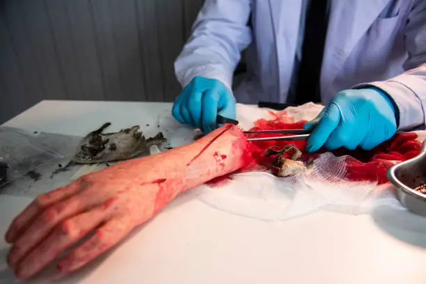 Photo of Anatomy dissection of a cadaver showing adductor canal using scalpel scissors and forceps cutting skin flap revealing important structures arteries veins nerves