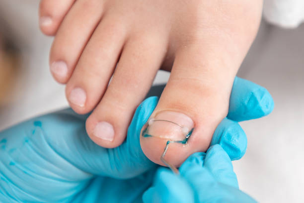 a podologist in blue gloves clean with curette a ingrown toenail. close-up of nail with titanium thread. top view. the concept of podology and chiropody - podiatrist customer service beauty spa imagens e fotografias de stock