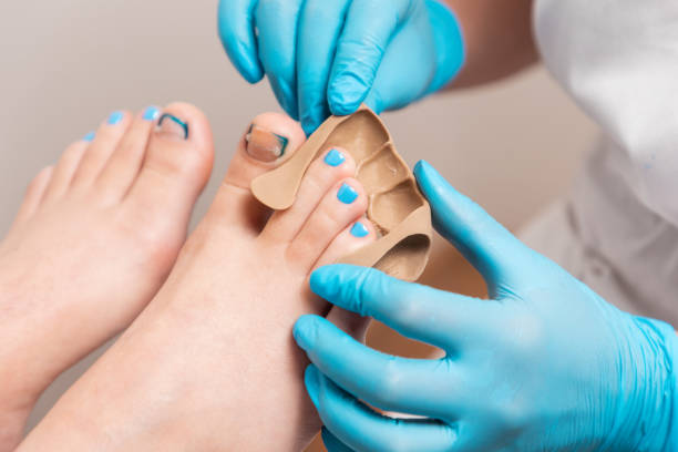 podólogo con guantes azules inserta una impresión de silicona para fijar la uña encarnada en el dedo gordo del pie del cliente. primer plano. el concepto de podología y podología - podiatrist customer service beauty spa fotografías e imágenes de stock