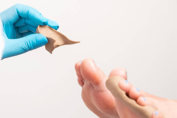 procedure in podiatry clinic. podiatrist in blue gloves inserts a silicone impression between client's toe fingers. close-up. copy space. the concept of podology and chiropody - podiatrist customer service beauty spa imagens e fotografias de stock