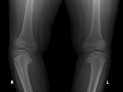 x ray image of blount disease or tibia vara on knee