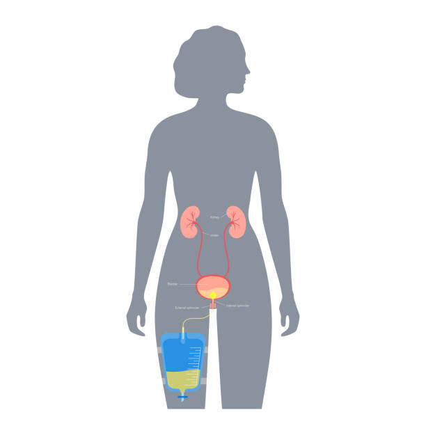 Foley Female 10+ Silhouette Of A Foley Catheters Stock Illustrations, Royalty-Free ...