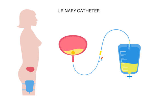 Urinary drainage bag Urinary catheter in the female body. Empty bladder and collect urine in leg bag. Tube from internal organs to urethra. Urethral drainage equipment. Difficulty peeing naturally flat vector illustration catheter stock illustrations