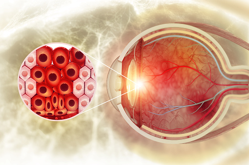 Eye disease, eye cancer, 3d illustration