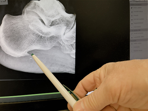 Espolón del talón en una radiografía del pie photo