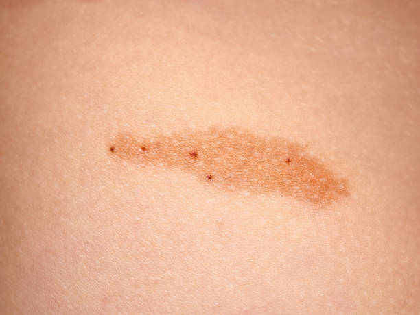 istock Birthmark on a 9 year old boy's back, no faces are shown 1403078447