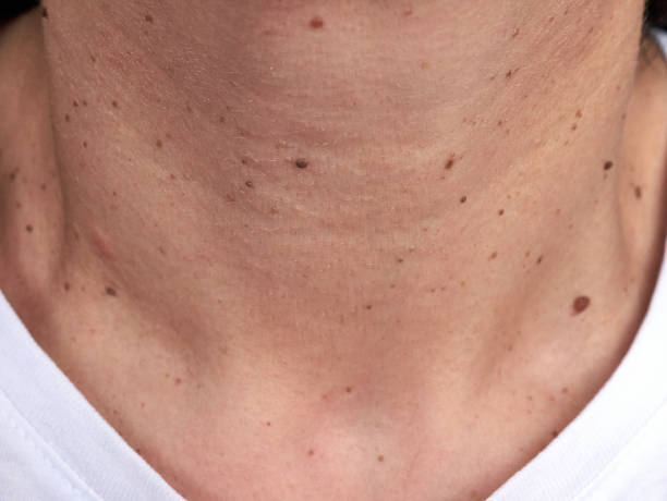 Neck of a woman with many small moles and warts Neck of a woman with many small moles and warts, no faces shown, close up wart stock pictures, royalty-free photos & images