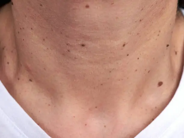 Neck of a woman with many small moles and warts, no faces shown, close up