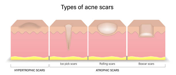 illustrazioni stock, clip art, cartoni animati e icone di tendenza di tipi di cicatrici da acne. problemi della pelle del viso. cicatrici ipertrofiche e cicatrici atrofiche. vettore per la pubblicità su bellezza e cure mediche. - cicatrice