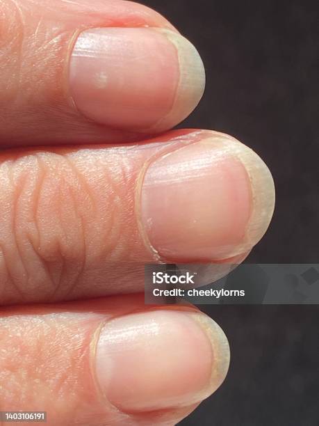 Terrys Nails Is Leukonychia Characterized By Opacification White Most Nail Missing Lunula And A Narrow Band Of Red Of Brown At Tip Stock Photo - Download Image Now - iStock Terrys Nails Is Leukonychia Characterized By Opacification White Most Nail Missing Lunula And A Narrow Band Of Red Of Brown At Tip Stock Photo - Download Image Now - iStock
