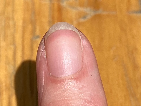 Las uñas de Terry son leuconiquias, caracterizadas por la opacificación blanca de la mayoría de las uñas, la falta de lúnula (media luna) y una estrecha banda de color rojo marrón en la punta. photo