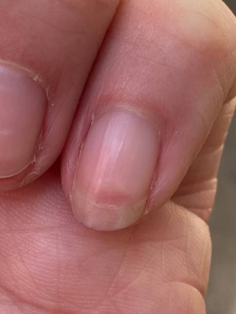 istock Terry's nails is leukonychia, characterized by opacification white most nail, missing lunula (half moon), and a narrow band of red of brown at tip 1403106475