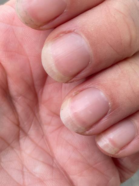 istock Terry's nails is leukonychia, characterized by opacification white most nail, missing lunula (half moon), and a narrow band of red of brown at tip 1403106496