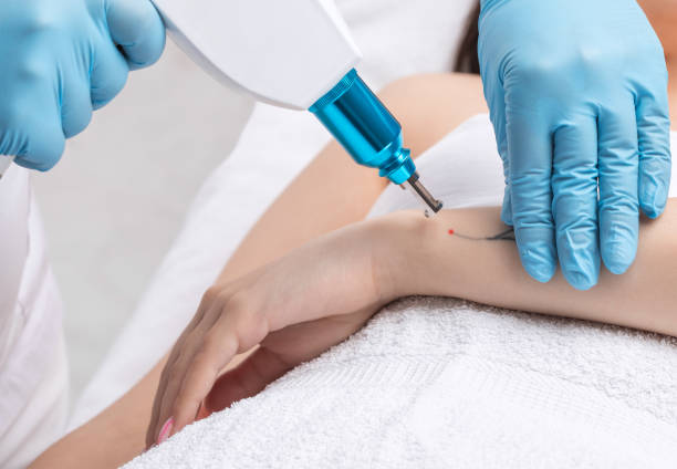 The doctor makes the procedure for laser tattoo removal on the girl's arm. stock photo