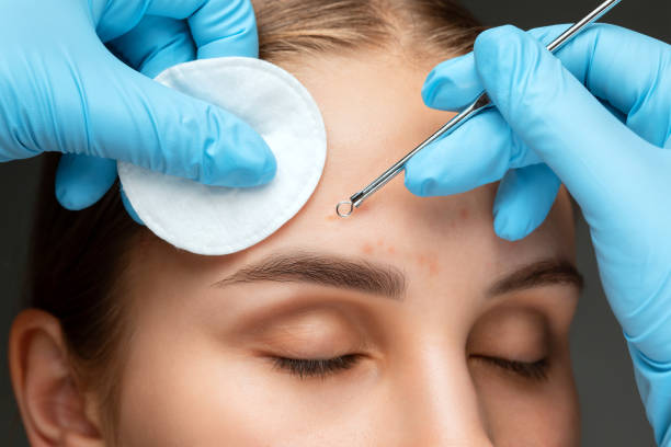 A procedure for cleansing the skin of the face from blackheads and acne. Cosmetologist treats problematic skin of a young woman's face in a beauty salon. Aesthetic cosmetology and makeup concept. stock photo