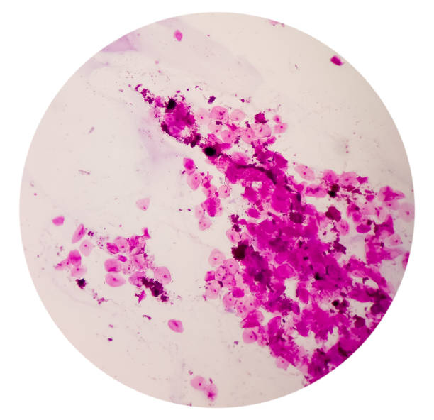 istock Prostatic Smear (PS) gram stain microscopic 10x show epithelial cells. Large number of gram positive Diplococci and few gram negative rods shape bacteria. 1403189230