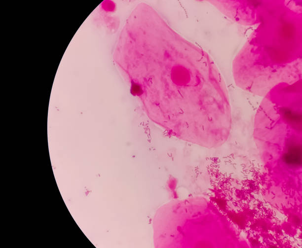 istock Prostatic Smear (PS) gram stain microscopic 40x show epithelial cells. Large number of gram positive Diplococci and few gram negative rods. 1403189256
