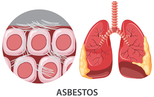 Asbestosis on human lungs illustration