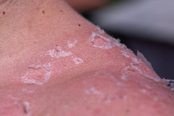 istock Peeling sunburned skin on back and shoulder 1403241015