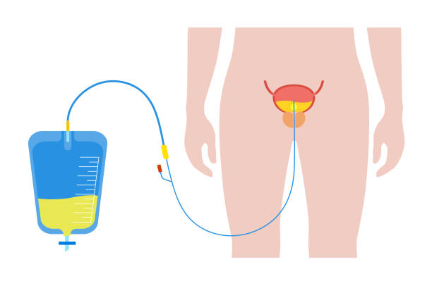 Urinary drainage bag Urinary catheter in male body. Empty bladder and collect urine in a leg bag. Tube from urethra to internal organ. Urethral drainage equipment. Prostate enlargement, difficulty peeing naturally vector. urinary system stock illustrations