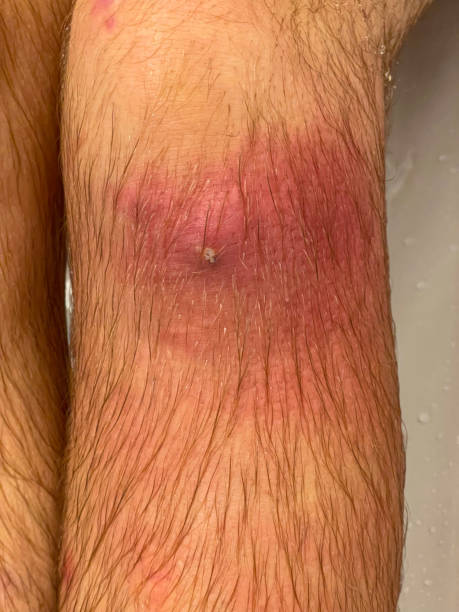istock VERTICAL Small cut on man's knee gets infected and filled with yellow puss. 1403472480