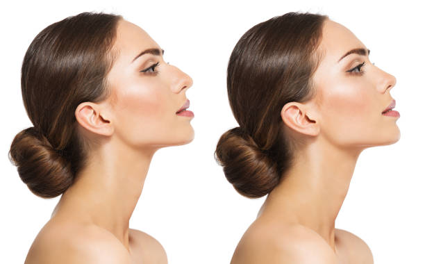 Woman Rhinoplasty. Women Nose Shape Before and After Plastic Surgery. Beauty Model Profile Side View over isolated White background stock photo