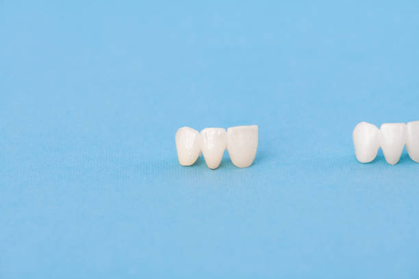 istock Teeth implant and crown installation process parts isolated on a blue background. Medically accurate 3D model. 1403561849