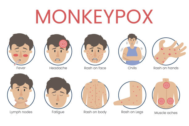 monkey pox virus concept showing the symptoms of the disease: fever, headache, rash on the body - 猴痘 插圖 幅插畫檔、美工圖案、卡通及圖標