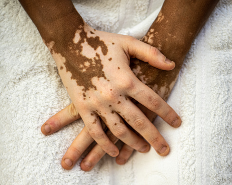 Details of skin tones on the hands of a young African woman with skin vitiligo,skin care and genetic melatonin change