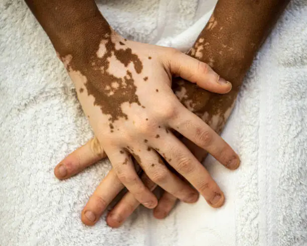 Photo of Details of skin tones on the hands of a young African woman with skin vitiligo,skin care and genetic melatonin change