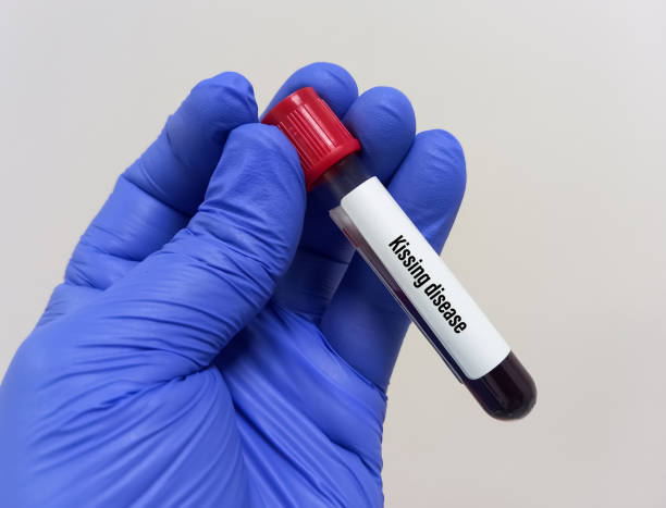 Blood sample for Kissing disease test, cause of Epstein-Barr virus (EBV), It's also called mono. Blood sample for Kissing disease test, cause of Epstein-Barr virus (EBV), It's also called mono. epstein barr virus photos stock pictures, royalty-free photos & images