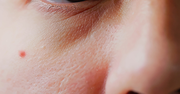 Closeup spot red scar acne pimple on face asian woman
