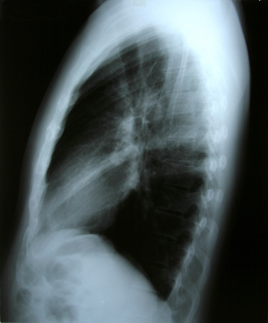 lung x-ray from the side with black background