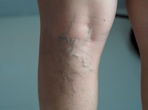 Close up of human foot with allergic rash dermatitis eczema