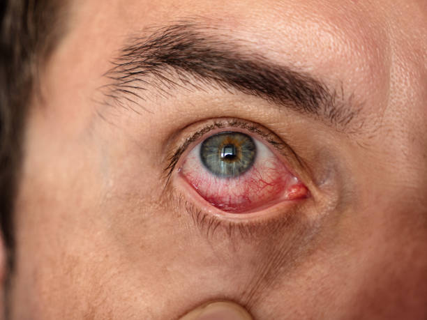 istock Man with red eye, macro. Conjunctivitis infection 1403806516