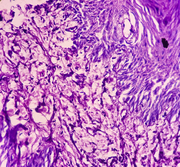 istock Microscopic image of chronic osteomyelitis from maxillary region tissue. 1403820466