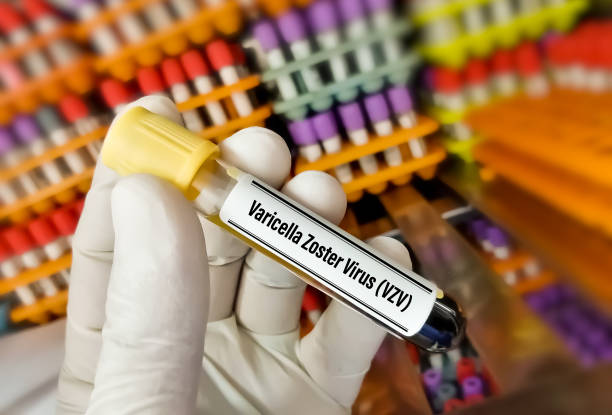 Blood sample tube for Varicella zoster virus or VZV test. stock photo