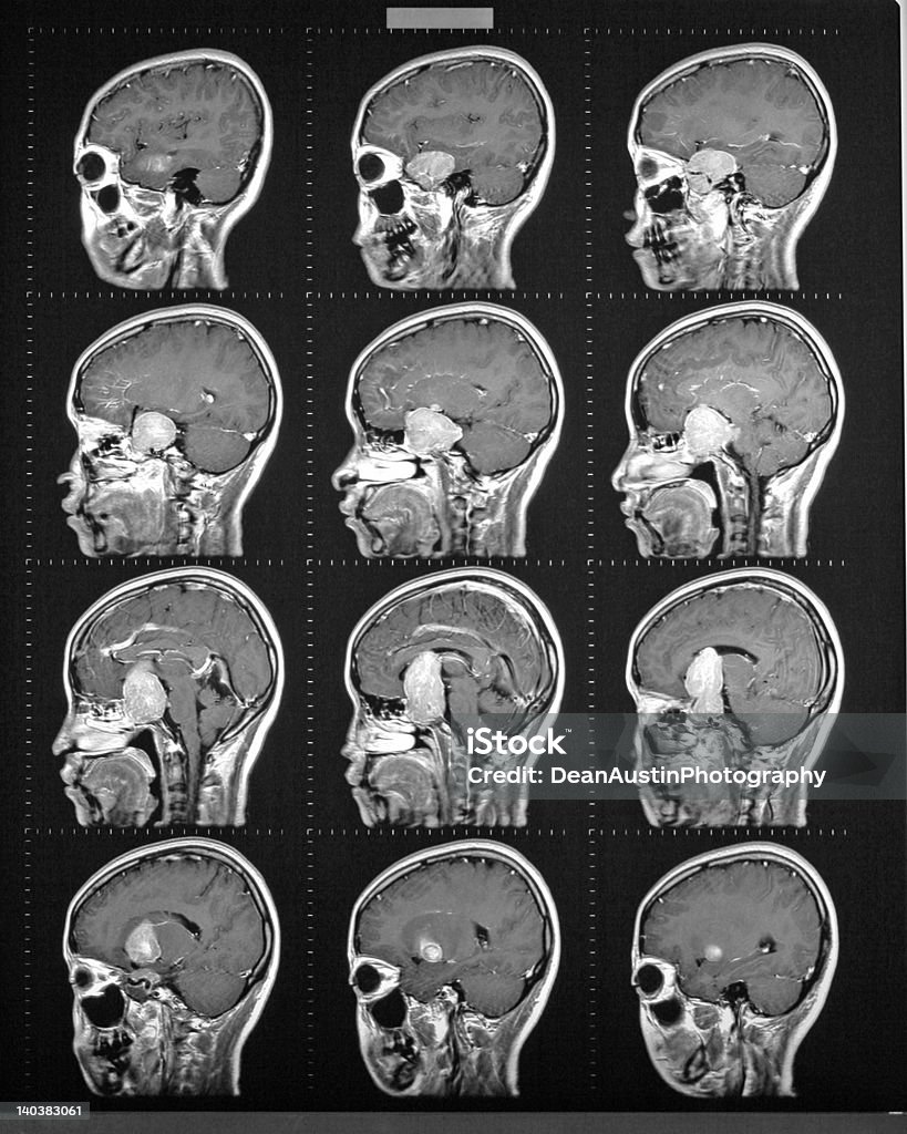 Por ressonância magnética do cérebro mostrando tumor - Royalty-free Cuidados de Saúde e Medicina Foto de stock